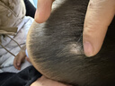 希格玛308白癜风治疗仪西格玛UVB银屑病紫外线准分子激光光疗仪医院同款 【手持全身针对难点部位】雷神60高强度308nm 实拍图