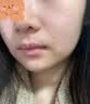 藤石制药激光点痣后脸部去红印黑印凹陷修复凝胶祛痣疤痕膏淡化红印色素DS 两盒装第二盒半价 实拍图