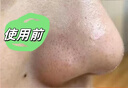 TRUVOER德国黑头铲超声波去黑头仪电动吸黑头神器毛孔清洁导入导出去粉刺神器美容仪生日礼物纪念日送女生 顶配款【LED红蓝光护肤+细嫩毛孔+离子导出】 实拍图