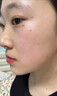 藤石制药激光点痣后脸部去红印黑印凹陷修复凝胶祛痣疤痕膏淡化红印色素DS 单盒装 实拍图