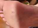 森卓止尤净跖疣专用非药脚底趾疣根鸦胆子脚上疣体hpv祛疣非药膏去除 【跖尤肉刺】1盒装去尤乐 实拍图