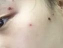 TANZI院线级810拉杆箱脱毛仪冰点激光脱毛光子嫩肤爆款家用美容院仪器 升级款【双风扇】黑色 十靶条 实拍图
