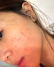 维特丝水杨酸祛痘药膏祛痘修复淡痘印壬二酸乳膏胶态硫烟酰胺凝胶青春期 实拍图