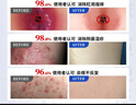 久卜制药湿疹膏皮肤瘙痒皮炎真菌感染肛门瘙痒止痒专用肛周湿疹潮湿 1盒装 实拍图