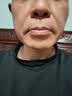 希格玛308白癜风治疗仪银屑病家用紫外线准分子激光光疗仪UVB西格玛医用 15强度 NFD 308nm光疗仪+光疗礼包 实拍图