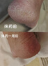 [科田]华佗膏 脚后跟真菌感染干裂脱皮专用药角化型脚气顽固性脚起硬皮脚干裂特新效药膏脚趾缝溃烂开裂药 华佗膏1支+盐酸特比萘芬喷雾剂1瓶 【一喷一抹】 实拍图