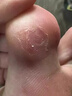 脚医生鸡眼膏10ml/盒鸡尤净脚底跖疣成人去脚根低老茧鸡眼贴手部脚趾 实拍图