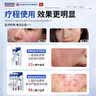 BKWILD医用重组生长因子凝胶胶原蛋白点痣喷人表皮祛疤痕膏修复生肌膏 实拍图