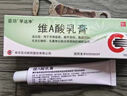 维A酸乳膏去疣体特新效期药扁平疣专用药去疣类药膏去脖子小肉粒颈部瘊子去尤瘊小肉粒去疣膏瘊子肉刺肉粒 1盒装【国药准字脱疣瘊】 瘊子去除国药准字药膏  放心购买 安心售后 实拍图
