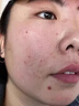 点痣后疤痕修复膏除疤膏凹坑增生凸起点痣后去脸上红印黑印激光术后点斑成人儿童专用修复淡化凝胶液 单盒【体验装】 实拍图