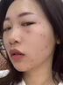 ASTACURE医用去痣点痣膏祛痣膏専用药脸部不留疤激光笔药水官方正品男女士 实拍图