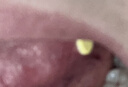 意可贴 醋酸地塞米松口腔贴片 0.3mg*5片 用于非感染性口腔黏膜溃疡 实拍图
