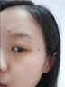 ASTACURE医用去痣点痣膏祛痣膏専用药脸部不留疤激光笔药水官方正品男女士 实拍图