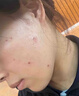 藤石制药激光点痣后脸部去红印黑印凹陷修复凝胶祛痣疤痕膏淡化红印色素DS 三盒装买二送一 实拍图