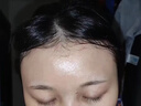维特丝水杨酸祛痘膏祛痘印淡痘印壬二酸15%凝胶胶态硫烟酰胺乳膏青春期 实拍图