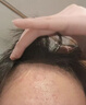 维特丝水杨酸祛痘膏祛痘印淡痘印壬二酸15%凝胶胶态硫烟酰胺乳膏青春期 实拍图