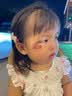 DR.MICKEY医用重组生长因子凝胶牛碱性成纤维细胞点痣喷人表皮祛疤痕膏修复 实拍图