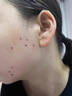 华美科医用重组人体表皮生长因子点痣疤痕修复凝胶烫软膏伤口愈合15g1支 实拍图