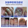 涩冈制薬日本灰指甲特殊专用重度灰指甲发黄真菌感染脱甲坏甲有效非药*3盒 实拍图