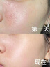 医用精华液械字号收缩毛孔粗大修复细致去黑头粉刺闭口男士女士祛痘印黑色素沉淀控油淡化痘印痘坑透明质酸钠 实拍图
