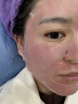 沃朗森医用面膜械字号冷敷贴医美术后补水修复祛痘印消炎透明质酸钠礼盒 实拍图