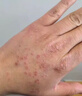 涩冈制薬日本湿疹药膏湿疹皮肤瘙痒皮炎皮癣真菌感染止痒膏专用肛门周1盒 实拍图