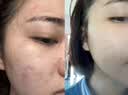 Colongon青少年爽肤水保湿精华水补水杏仁酸水杨酸控油祛痘收毛孔去闭口 实拍图