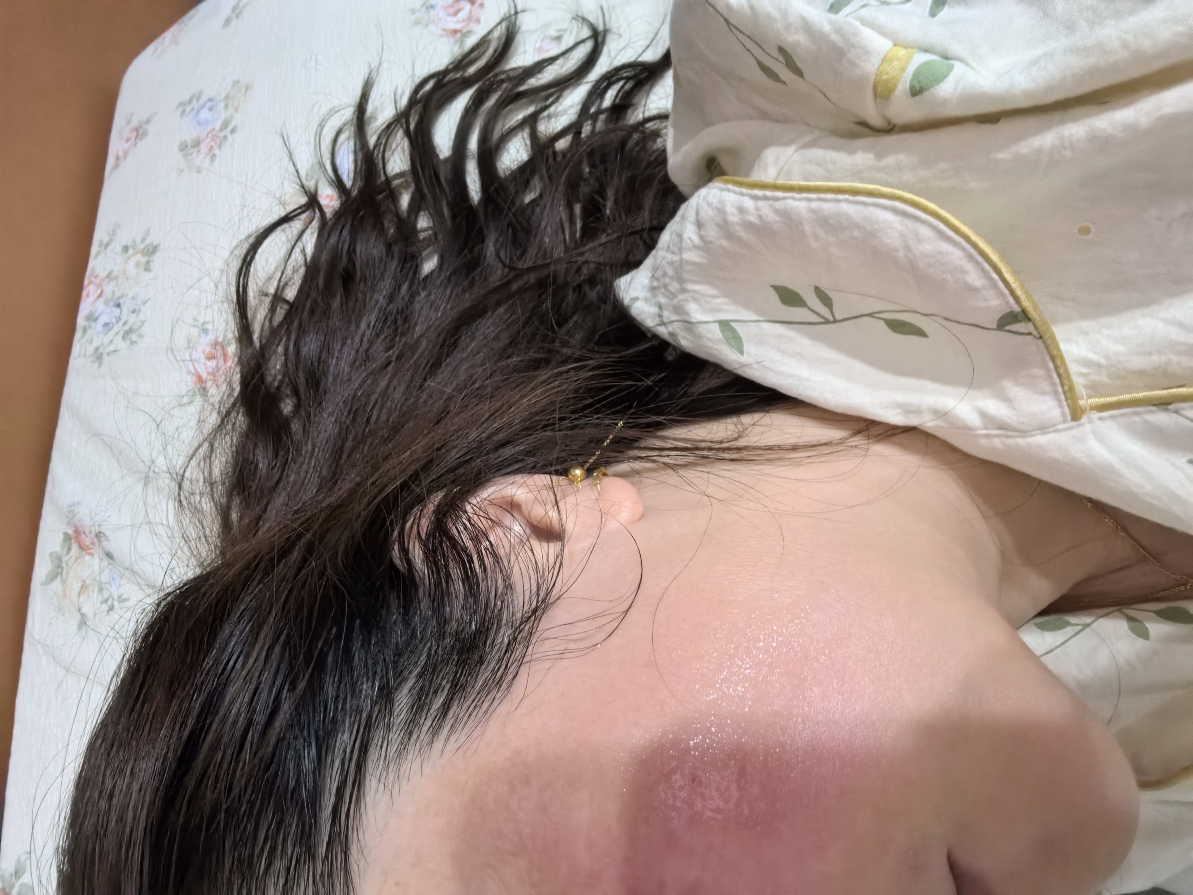 沃朗森医用胶原蛋白修护凝胶修复敷料重组三型人源化祛痘印淡化生长因子 实拍图