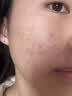 DR.MICKEY医用重组生长因子凝胶牛碱性成纤维细胞点痣喷人表皮祛疤痕膏修复 实拍图