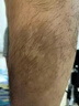 光专嘉308白癜风治疗仪紫外线光疗仪UVB牛皮癣白斑灯医院家用同款窄谱波 25强度 9颗进口灯珠 面积3 医疗专用照射灯照光仪器机器非准分子激光 实拍图