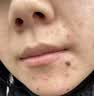 大水滴祛痘精华3.0全脸净痘修护改善痘肌姨妈痘敏感肌男女青春痘护肤品 实拍图