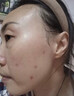 藤石制药激光点痣后脸部去红印黑印凹陷修复凝胶祛痣疤痕膏淡化红印色素DS 单盒装 实拍图