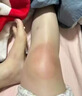 宝芝林香港 膝盖疼痛滑膜炎关节痛专用积液半月板损伤热敷膏药贴 实拍图