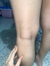 关德兴香港宝芝林静脉曲张专用膏蚯蚓腿精索血管堵塞疏通凝胶可搭弹力袜 实拍图