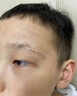 BKWILD医用重组生长因子凝胶胶原蛋白点痣喷人表皮祛疤痕膏修复生肌膏 实拍图