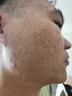 丽芙阿达帕林凝胶0.1%*16g/支*2第三代维a酸乳膏改善毛孔粗大去黑头医用正品祛痘痤疮专用青少年修复淡化痘印药膏 实拍图