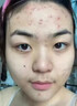 DR.MICKEY医用重组生长因子凝胶牛碱性成纤维细胞点痣喷人表皮祛疤痕膏修复 实拍图