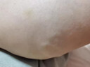 关德兴香港宝芝林静脉曲张专用膏蚯蚓腿精索血管堵塞疏通凝胶可搭弹力袜 实拍图