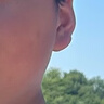 DR.MICKEY医用重组生长因子凝胶牛碱性成纤维细胞点痣喷人表皮祛疤痕膏修复 实拍图