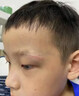 BKWILD医用重组生长因子凝胶胶原蛋白点痣喷人表皮祛疤痕膏修复生肌膏 实拍图