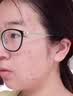 胶原蛋白肽三型寡肽原液蓝铜胜肽冻干粉祛斑后修复医用美容院专用 20对【40瓶】医美院线专用祛斑后修复冻干粉 实拍图