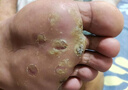 Dr.HillGod鸡i眼膏去肉刺根膏去非无痛脱落连拔跖疣专用脚根底瘊子搭鸡i眼贴 实拍图