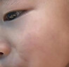 DR.MICKEY医用重组生长因子凝胶牛碱性成纤维细胞点痣喷人表皮祛疤痕膏修复 实拍图
