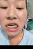 皓牛补牙树脂材料自己在家补牙齿龋齿神器牙呀洞栋填充剂高硬度医用 实拍图