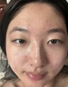 OHBT壬二酸15%凝胶水杨酸祛痘药膏祛痘淡化痘印坑消炎痤疮专用青少年 实拍图