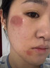 DR.MICKEY医用重组生长因子凝胶牛碱性成纤维细胞点痣喷人表皮祛疤痕膏修复 实拍图