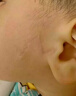 DR.MICKEY医用重组生长因子凝胶牛碱性成纤维细胞点痣喷人表皮祛疤痕膏修复 实拍图