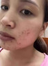 DR.MICKEY医用重组生长因子凝胶牛碱性成纤维细胞点痣喷人表皮祛疤痕膏修复 实拍图