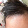 BKWILD医用重组生长因子凝胶胶原蛋白点痣喷人表皮祛疤痕膏修复生肌膏 实拍图