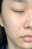 医用精华液械字号收缩毛孔粗大修复细致去黑头粉刺闭口男士女士祛痘印黑色素沉淀控油淡化痘印痘坑透明质酸钠 实拍图